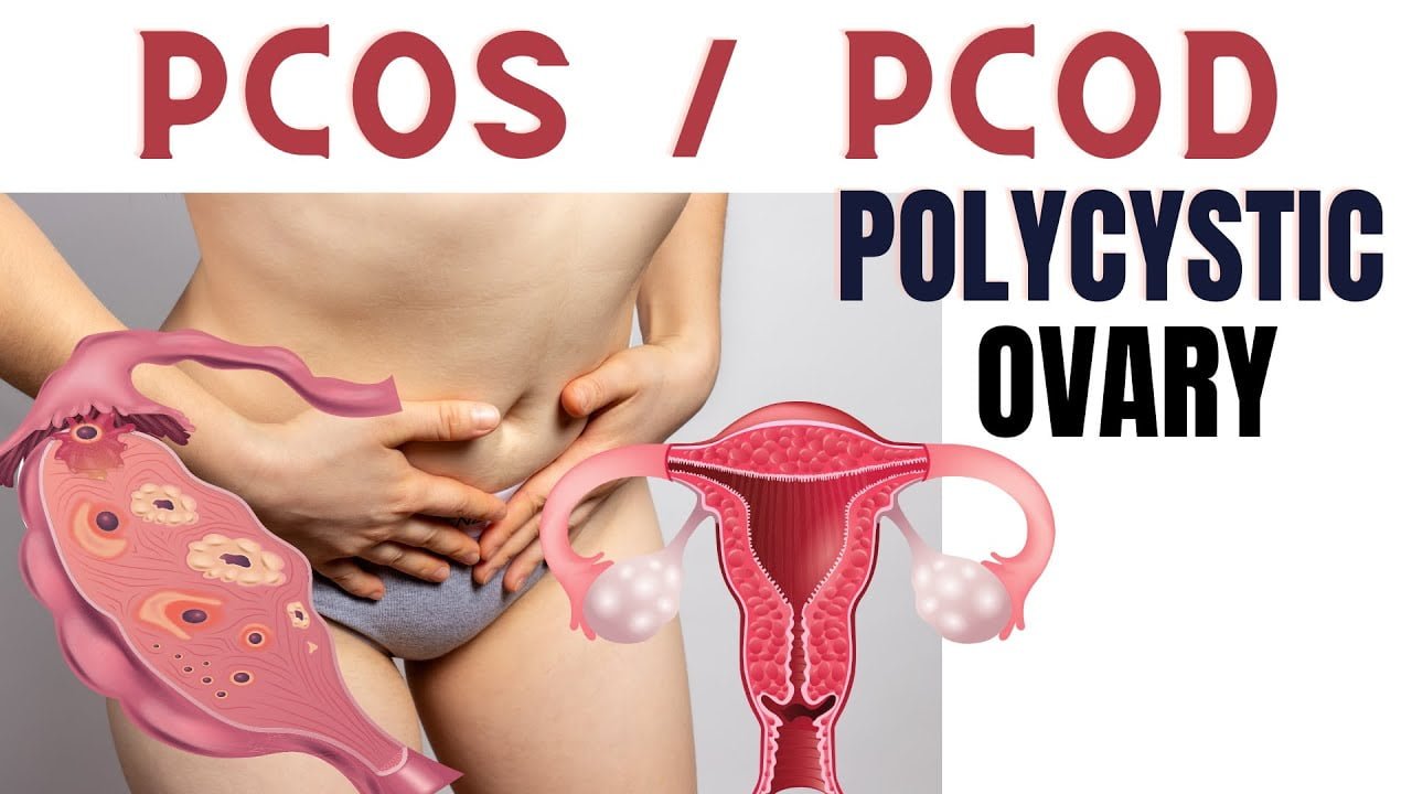 PCOD vs PCOS