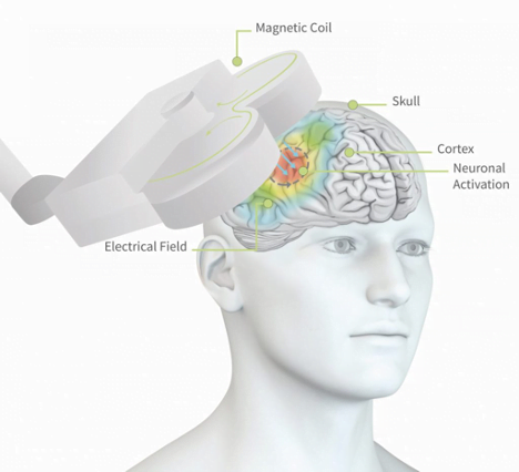 Revolutionizing Depression Treatment: The Power of Transcranial Magnetic Stimulation