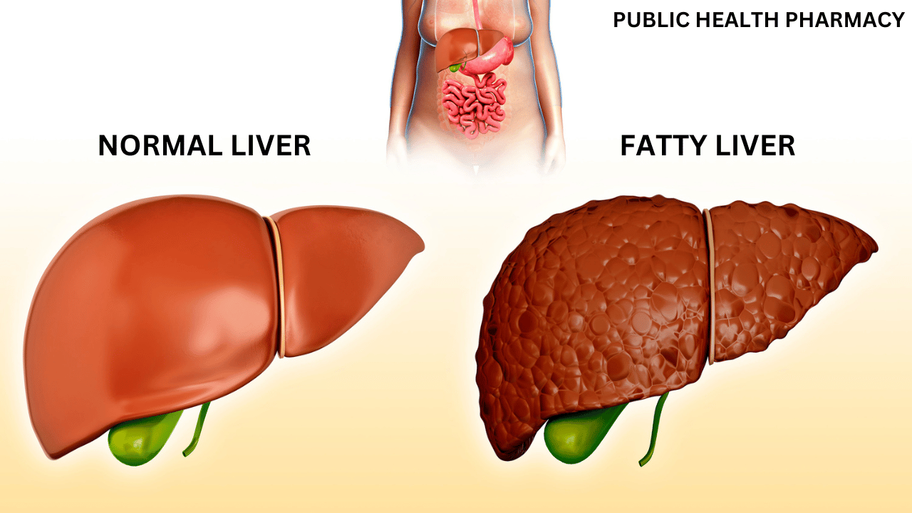 Grade 1 fatty liver